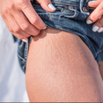 how to fix stretch marks